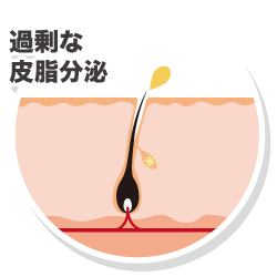 過剰な皮脂分泌