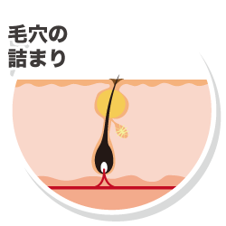 毛穴の詰まり