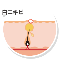 白ニキビ