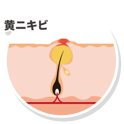 黄ニキビ