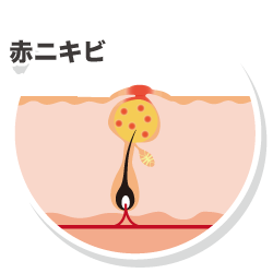赤ニキビ