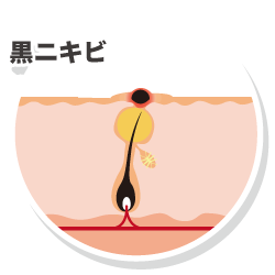 黒ニキビ