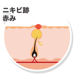 ニキビ跡赤み