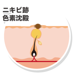 ニキビ跡色素沈殿
